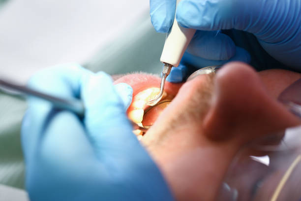 Best Emergency Wisdom Teeth Removal in Kewanee, IL